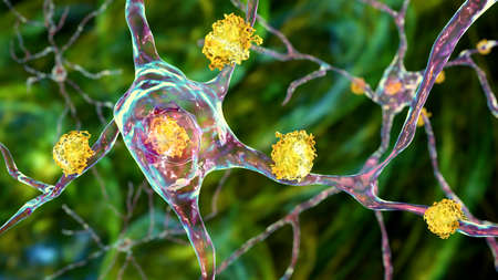Neuronal inclusions in Huntington's disease, 3D illustration. Inclusions are composed of mutated...