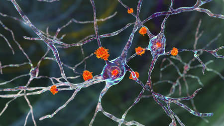 Neuronal inclusions in Huntington's disease, 3D illustration. Inclusions are composed of mutated...