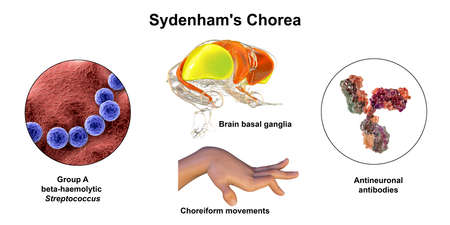 Sydenham's chorea, an autoimmune disease that results from Streptococcus infection, formation of...