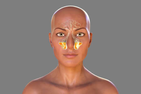 Sinusitis, inflammation of paranasal cavities. 3D illustration showing purulent inflammation of maxillary sinuses, antrum of Highmore, in a dark-skinned female personの写真素材