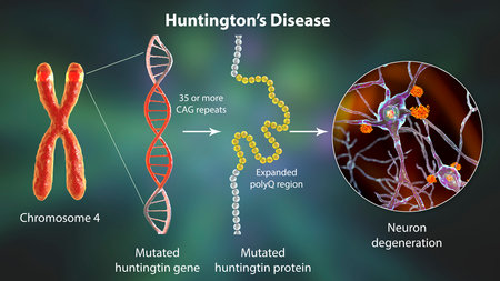 Molecular genesis of Huntington's disease, 3D illustration. Expansion of the CAG trinucleotide sequence in the htt gene causes production of mutated Huntingtin protein leading to neurodegenerationの写真素材