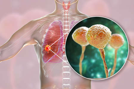 Lung mucormycosis, a lung disease caused by fungi Mucor, also known as black fungus, with close-up...