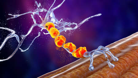 Degradation of motor neurons, conceptual 3D illustration. Motor neuron diseases are a group of neurodegenerative disorders including amyotrophic lateral sclerosis, progressive bulbar palsy and otherの写真素材