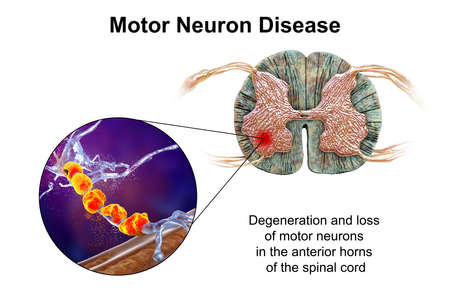 Motor neuron diseases, 3D illustration showing degeneration of motor neurons in anterior horns of...
