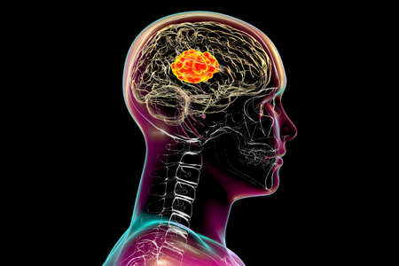 Brain mucormycosis, a brain lesion caused by fungi Mucor, also known as black fungus, 3D...