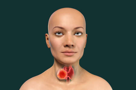 Thyroid cancer. 3D illustration showing thyroid gland with tumor inside human body