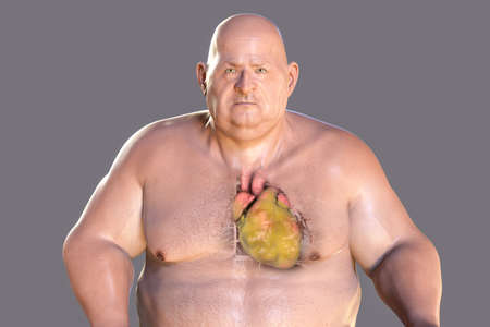 Obese heart in overweight man, 3D illustration. Concept of obesity and inner organs disease. Heart...