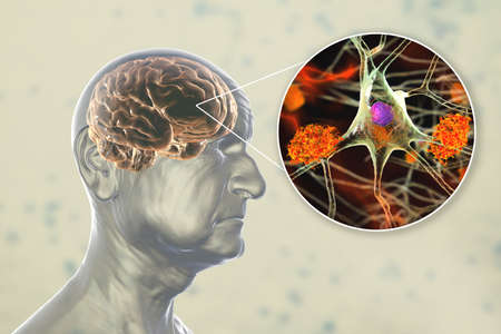 Dementia, conceptual 3D illustration showing an elderly person with progressive impairments of brain...