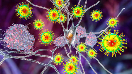 Infectious etiology of dementia. Neuropsychiatric sequelae of Covid-19. Viruses infecting neurons...