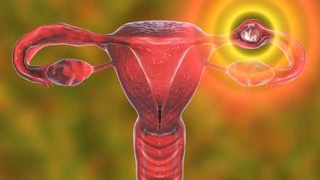Tubal ectopic pregnancy, 3D illustration showing an 8-week human fetus implanted in the fallopian...