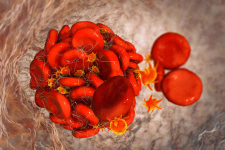Blood clot made of red blood cells, platelets and fibrin protein strands. Thrombus, 3D illustration....
