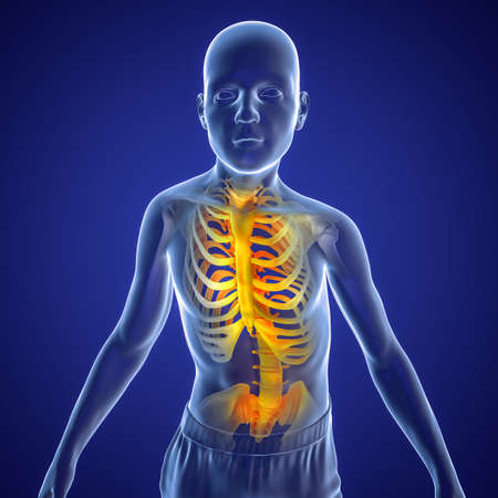 Scoliosis, 3D illustration. A human body with curved spine, uneven shoulders and hips. Spine curve...