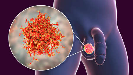 Testicular cancer, 3D illustration showing malignant tumor in the testis and close-up view of...