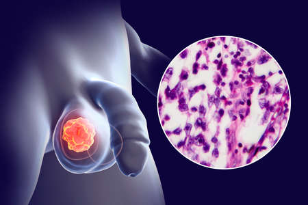 Testicular cancer, testicular seminoma, 3D illustration and light micrograph. Malignant tumor of the...