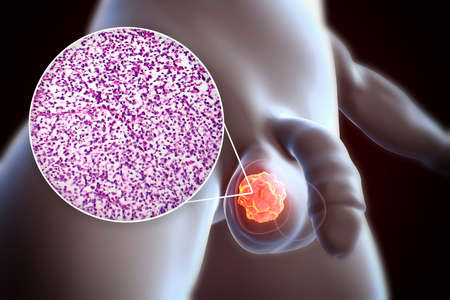 Testicular cancer, testicular seminoma, 3D illustration and light micrograph. Malignant tumor of the...