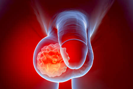 Testicular cancer, testicular seminoma, 3D illustration. Malignant tumor of the testis