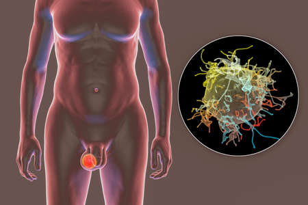 Testicular cancer, 3D illustration showing malignant tumor in the testis and close-up view of...