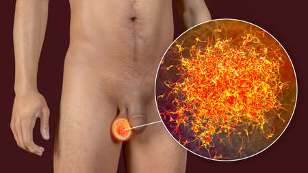 Testicular cancer, 3D illustration showing malignant tumor in the testis and close-up view of...