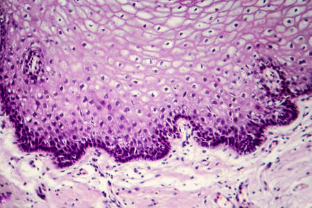 Cancer of cervix. Light micrograph of cervical biopsy. Photo under microscope. Selective focusの写真素材