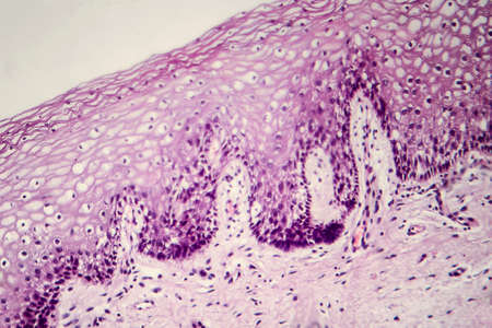 Cancer of cervix. Light micrograph of cervical biopsy. Photo under microscope. Selective focus