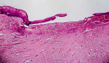 Cervical erosion, also known as eversion and ectropion, light micrograph. Photo under microscope,...