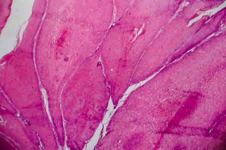 Condyloma acuminatum, also known as genital warts. Light micrograph, photo under microscope