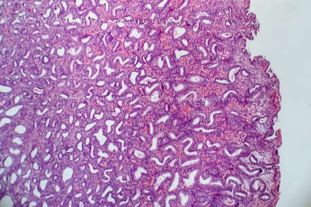Endometriosis, a disorder in which cells similar to those in the endometrium grow outside the uterus. Light micrograph, photo under microscopeの写真素材
