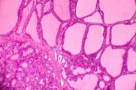 Toxic diffuse goiter, or Graves' disease, an autoimmune disease that affects the thyroid. Light...