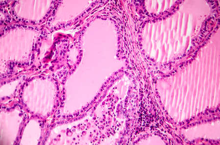 Toxic diffuse goiter, or Graves' disease, an autoimmune disease that affects the thyroid. Light micrograph shows hyperplastic thyroid follicles, papillary infoldingsの写真素材