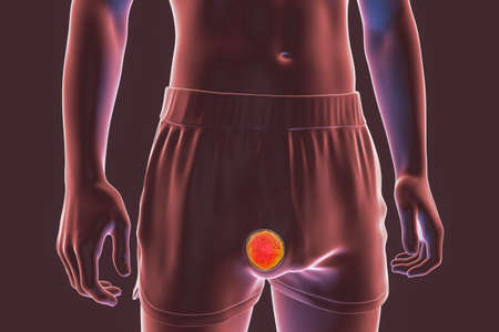 Testicular cancer, testicular seminoma, 3D illustration. Malignant tumor of the testis