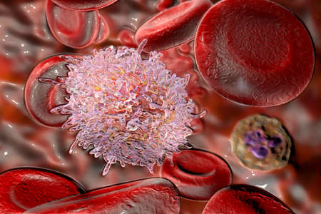Hairy cell leukemia, 3D illustration. It is a hematological malignancy, chronic lymphocytic...