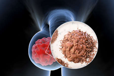 Testicular cancer, medical 3D illustration showing malignant tumor in the testis and close-up view...