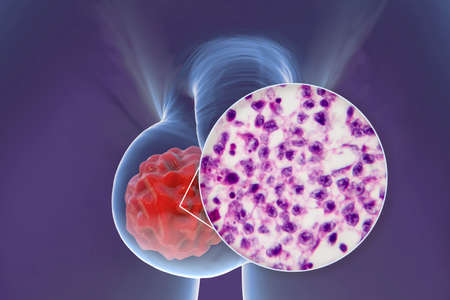 Testicular cancer, testicular seminoma, medical 3D illustration and light micrograph. Malignant...