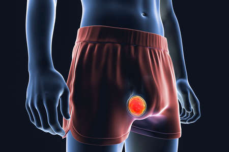 Testicular cancer, testicular seminoma, choriocarcinoma, teratoma or other tumor of the testis, 3D illustrationの写真素材