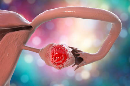 Ovarian cancer, 3D illustration showing malignant tumor in the left ovary