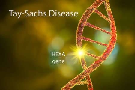Tay-Sachs disease, 3D illustration. A genetic disorder that progressively destroys brain neurons, is...
