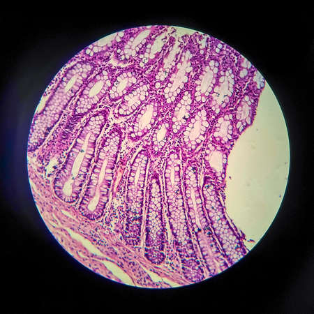 Bacillary dysentery, light micrograph, photo under microscope showing presence of bacteria and accumulation of inflammatory cells in intestinal epitheliumの写真素材