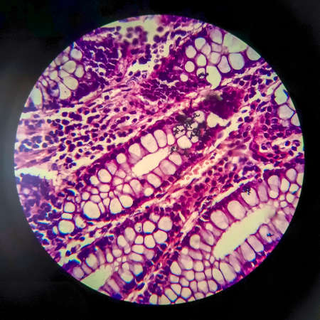 Bacillary dysentery, light micrograph, photo under microscope showing presence of bacteria and accumulation of inflammatory cells in intestinal epitheliumの写真素材