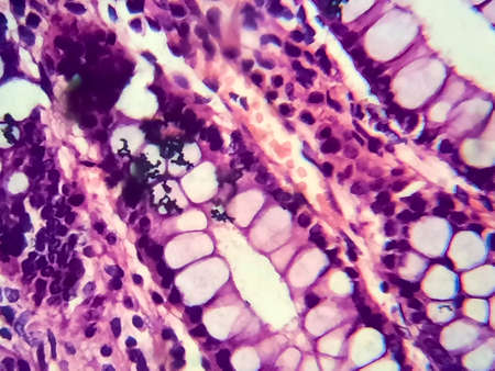 Bacillary dysentery, light micrograph, photo under microscope showing presence of bacteria and accumulation of inflammatory cells in intestinal epitheliumの写真素材
