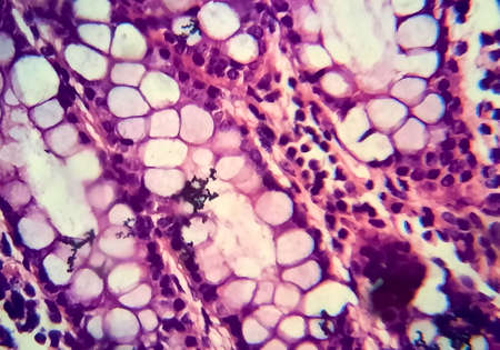 Bacillary dysentery, light micrograph, photo under microscope showing presence of bacteria and accumulation of inflammatory cells in intestinal epitheliumの写真素材