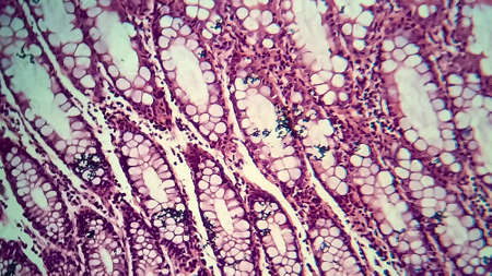 Bacillary dysentery, light micrograph, photo under microscope showing presence of bacteria and accumulation of inflammatory cells in intestinal epitheliumの写真素材