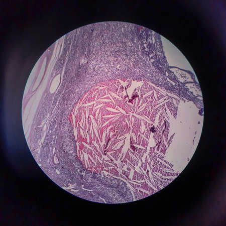Thyroid follicular carcinoma, light micrograph, photo under microscopeの写真素材