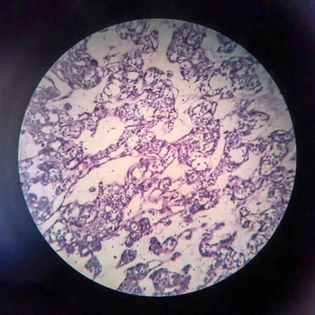 Thyroid follicular carcinoma, light micrograph, photo under microscopeの写真素材