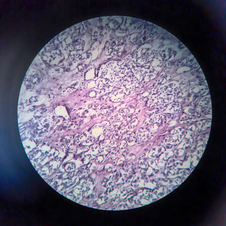 Thyroid follicular carcinoma, light micrograph, photo under microscopeの写真素材