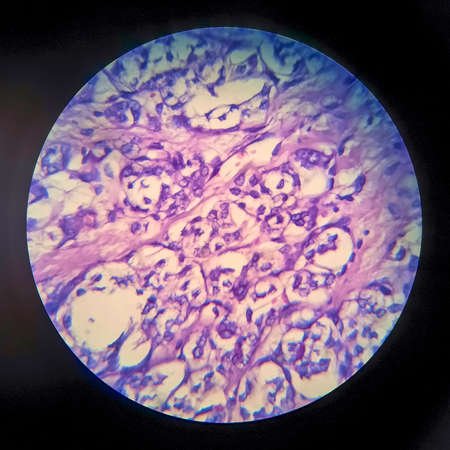 Thyroid follicular carcinoma, light micrograph, photo under microscopeの写真素材