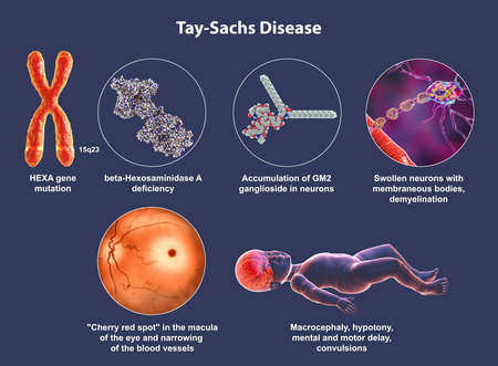 Tay-Sachs disease, 3D illustration. A genetic disorder that progressively destroys brain neurons, is...