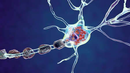Brain neurons in lysosomal storage diseases, Tay-Sachs, Niemann-Pick, Fabry and other. 3D...