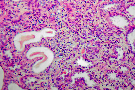 Chronic pyelonephritis, light micrograph, photo under microscope