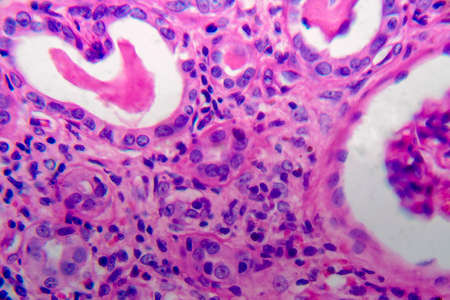 Chronic pyelonephritis, light micrograph, photo under microscope