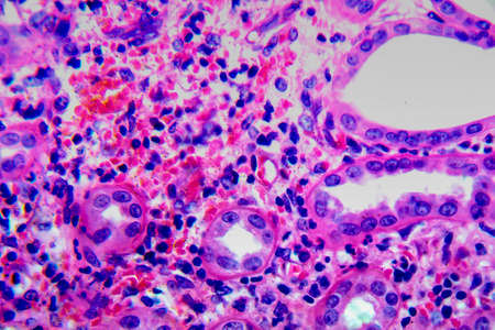 Chronic pyelonephritis, light micrograph, photo under microscopeの写真素材